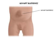 Figure showing the appearance of an umbilical hernia