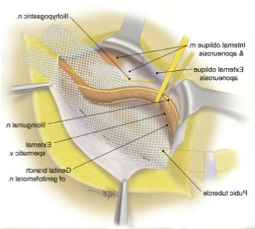 Figure showing Chronic Groin Pain