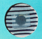 Figure showing a polypropylene patch covering the hernia