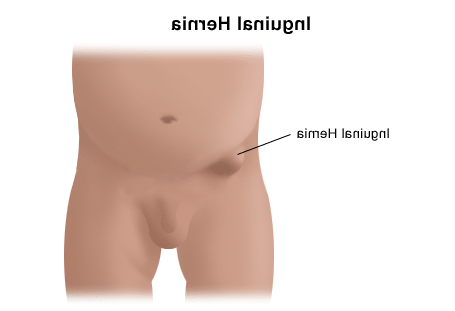 Inguinal Hernia diagram